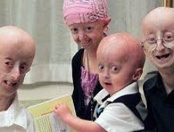 Penelitian Baru Temukan Potensi Pengobatan untuk Penyakit Langka ‘Progeria’