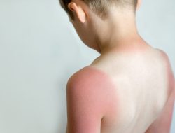 Awas Sunburn! Paparan Sinar Matahari Berlebihan Bisa Sebabkan Kerusakan Kulit