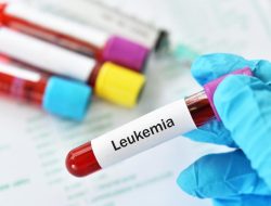 Leukimia Penyakit Kanker Darah yang Perlu Diwaspadai