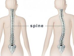 Kenali Gejala dan Cara Efektif Mengatasi Skoliosis Sebelum Terlambat!