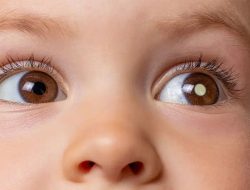 Retinoblastoma: Penyakit Mata yang Mengancam Jiwa Anak-anak